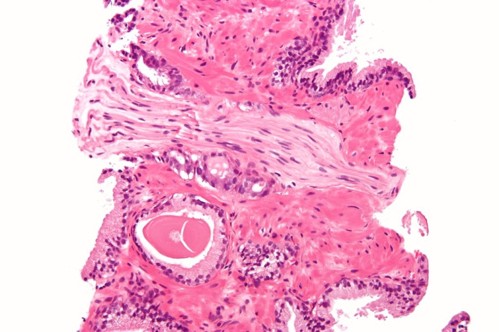 1280px-Prostatic_adenocarcinoma_with_perineural_invasion