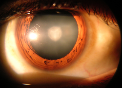 250px-Cataract_in_human_eye